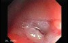 Colon Angiodysplasia (15 of 24)