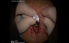 Cervical Arthrodesis - Anterior Approach