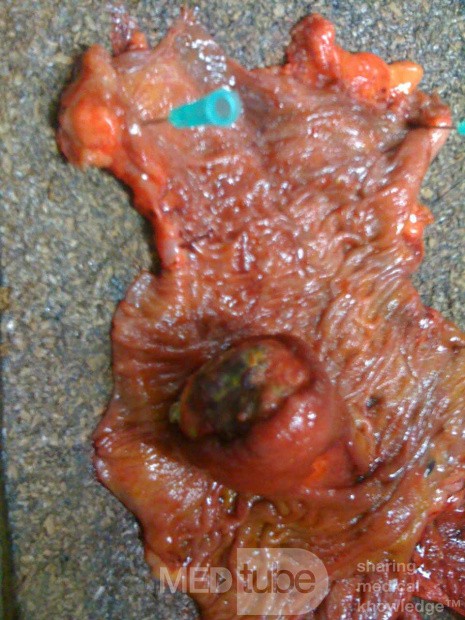 Ascending Colon Intussusception due to a Adenocarcinoma (4 of 6)