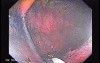 Sessile Tubulovillous Adenoma (10 of 11)