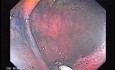 Sessile Tubulovillous Adenoma (10 of 11)