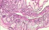 Small cell carcinoma of the lung that invades the upper and
 the middle third of the Esophagus (5 of 7)