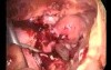 Laparoscopic Treatment Of Acute Pevic Inflamation Disease