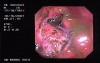 Gastric Adenocarcinoma - Obstruction 7