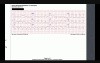 ECG Case 2