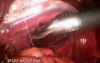 Hiatal Hernia