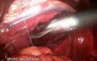 Hiatal Hernia