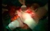 Open Right Hemicolectomy – Technical Principles - Operation No 2 - Part 4