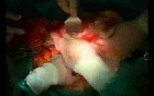Open Right Hemicolectomy – Technical Principles - Operation No 2 - Part 4