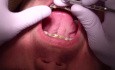 Orthodontics Case #1 - Currently 10 Months In Fixed Ortho Appliances