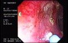 Radiation Proctosigmoiditis (11 of 14)