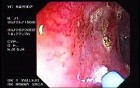 Radiation Proctosigmoiditis (11 of 14)