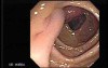Stalked Polyp - Polypectomy (1 of 6)