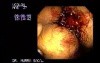 Large and long stalk villous adenoma inserting in the rectal dentate line, appearing as a multi lobular mass (2 of 2)