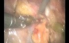Intersphincteric Dissection Followed by Robotic Abdominoperineal Resection for Anterior Rectal Cancer