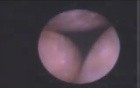 Perioscope, A Dental Endoscope For Non-Surgical Treatment