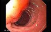 Adenocarcinoma of Papilla of Vater (1 of 5)