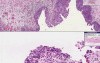 Bladder - Urothelial Carcinoma (Transitional Cell Carcinoma) In-Situ