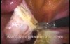 Laparoscopic Bilateral Adnexectomy With Only Two Trocarts