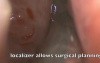 Cystic fibrosis - FESS