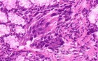 Ovarian Carcinoma Metastatic to Stomach and Duodenum (14 of 20)