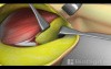 Mastectomy