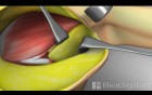 Mastectomy