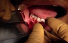 Part 4/8: Root Coverage Surgery - Mandibular Premolar - Placement Into Recipient Site