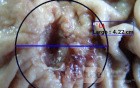 Adenocarcinoma of the Antrum and incisura angularis (8 of 12)