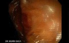 Upper GI Bleeding Due to Esophageal Varices - Closer Look at the Fibrin Plug