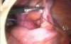 Laparoscopic appendectomy