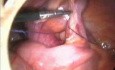 Laparoscopic appendectomy