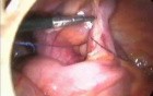 Laparoscopic appendectomy