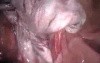 Laparoscopic Cystectomy