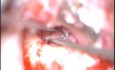 MRM Cholesteatoma EAC Fistula Sai 271108