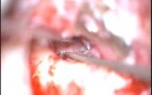 MRM Cholesteatoma EAC Fistula Sai 271108