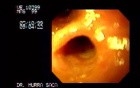 Choledochoduodenostomy