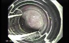 Ligation of Esophageal Varices - Beginning of the Treatment
