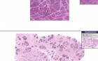 Hyperplasia of lactation - Histopathology - Breast