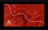 Uterine Fibroid Embolization - 3D Medical Animation
