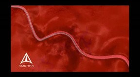 Uterine Fibroid Embolization - 3D Medical Animation