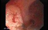 Familial Adenomatous Polyposis (22 of 36)
