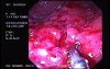 Severe Case Of Ulcerative Colitis (5 of 6)