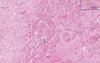 Partial infarct - Histopathology - Pituitary