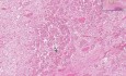Partial infarct - Histopathology - Pituitary