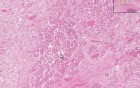 Partial infarct - Histopathology - Pituitary