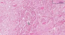 Partial infarct - Histopathology - Pituitary