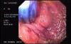 Esophageal Achalasia - Endoscopic Maneuvers