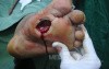 Diabetic foot ulcer - neuropathic -associated with ostemyelitis 