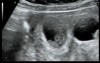 Transvaginal Fetal Reduction of a Twin Within a One Sac Quadruplet Pregnancy